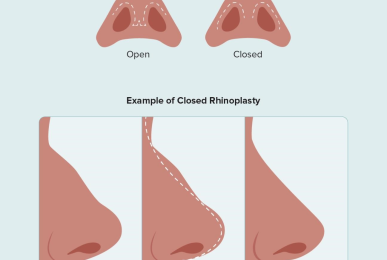 wpid-1111075-Everything-to-Know-About-a-Closed-Rhinoplasty-1296x728-header-body-1296x1507.png