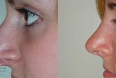 wpid-rhinoplasty-570-view-1-thumbnail.jpg